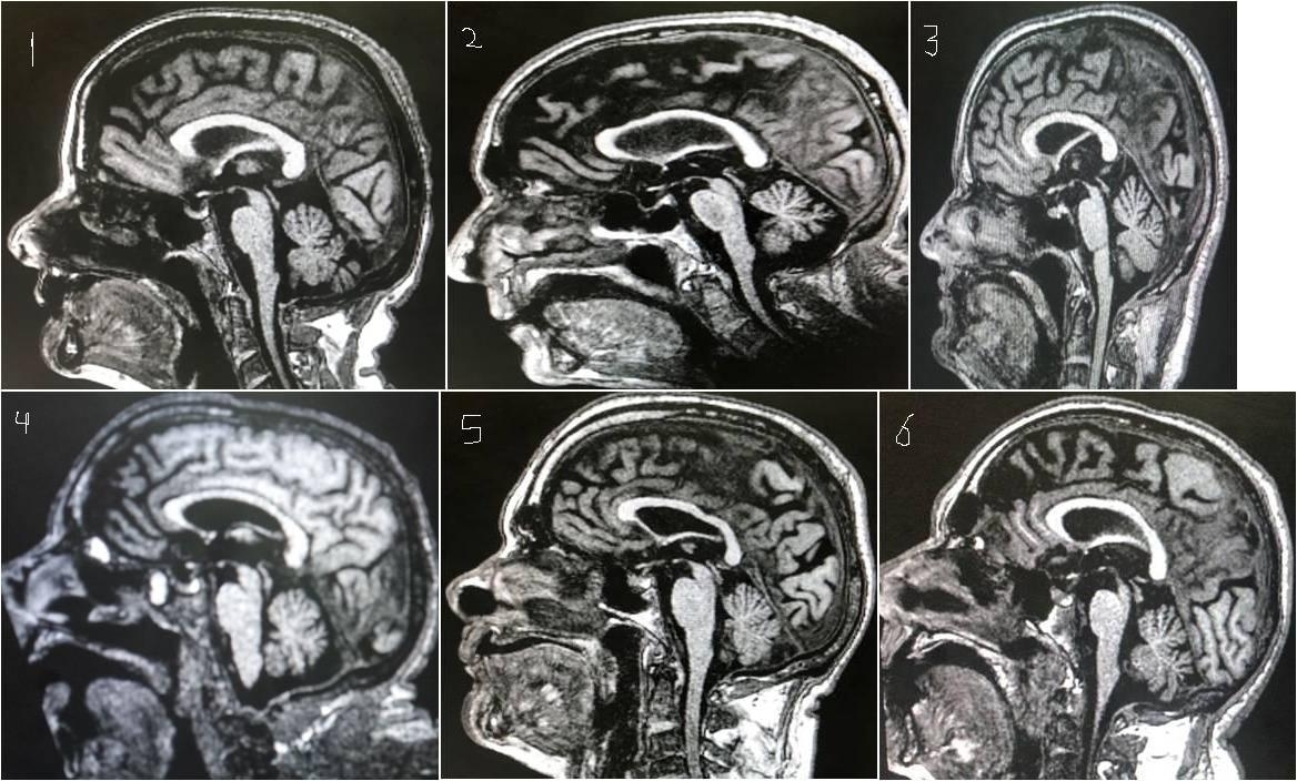Methylphenidate in Progressive Supranuclear Palsy [PSP] Old drug, New